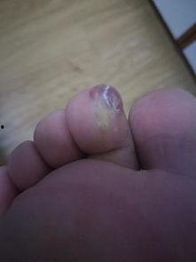 脚趾头红肿的图片,脚趾头红肿原因解析及应对策略